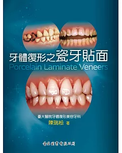牙體復形之瓷牙貼面