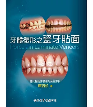 牙體復形之瓷牙貼面