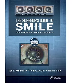 The Surgeon’s Guide to Smile: Small Incision Lenticule Extraction