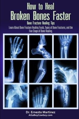 How to Heal Broken Bones Faster. Bone Fracture Healing Tips: Learn About Bone Fracture Healing Foods, Types of Bone Fractures, and the Five Stages of